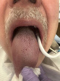 Figure 2: Clinical appearance of tongue three months after laser debridement Figure 2: Clinical appearance of tongue three months after laser debridement
