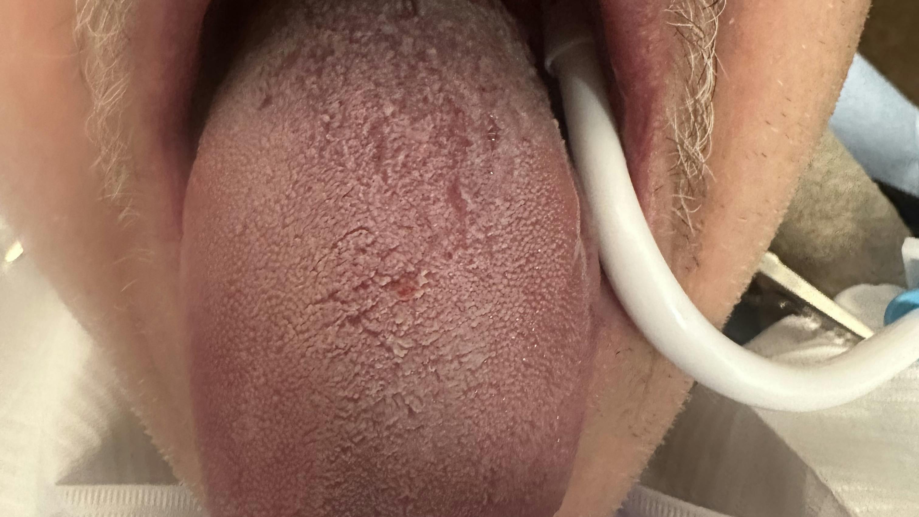 Clinical appearance of tongue three months after laser debridement
