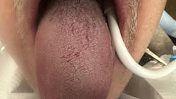 Clinical appearance of tongue three months after laser debridement Clinical appearance of tongue three months after laser debridement