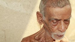 malnourished man malnourished man