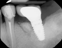 x-ray of an implant x-ray of an implant