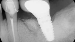 x-ray of a dental implant x-ray of a dental implant