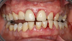 clinical photo of periodontal disease clinical photo of periodontal disease