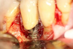 fractured dental implant fractured dental implant