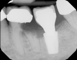 changes in dental implant position changes in dental implant position