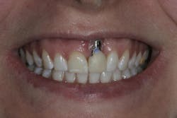 dental implant recession dental implant recession
