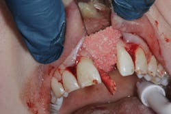 grafting around an exposed dental implant grafting around an exposed dental implant