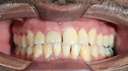 Dental implant recession around an anterior implant due to jaw-related soft tissue changes
