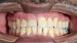 Dental implant recession around an anterior implant due to jaw-related soft tissue changes Dental implant recession around an anterior implant due to jaw-related soft tissue changes