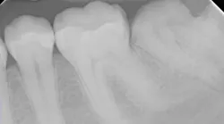 ferrule