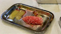 Figure 3: Clinical photo of a fabricated “sticky bone” by using particulate allograft mixed with solid-PRF fragments (cut up PRF membranes) with the addition of liquid-PRF. Figure 3: Clinical photo of a fabricated “sticky bone” by using particulate allograft mixed with solid-PRF fragments (cut up PRF membranes) with the addition of liquid-PRF.