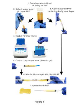 Figure 1: e-PRF preparation protocol. 1) Whole blood was centrifuged at 2000 × g for eight minutes. The upper layer (yellow layer) shows the liquid plasma layer. 2) The uppermost layer of platelet-poor plasma (PPP) was collected in a syringe. 3) The collected PPP was heated in a heat block device at 75°C for 10 minutes and thereafter 4) cooled to room temperature for approximately 10 minutes. An injectable albumin gel was then prepared. 5) The liquid platelet-rich layer (liquid-PRF), including the buffy coat layer with accumulated platelets and leukocytes, was collected in a separate syringe. 6) The albumin gel and native liquid PRF were then thoroughly mixed by utilizing a female‒female luer lock connector. 7) Injectable e-PRF in final ready form. Figure 1: e-PRF preparation protocol. 1) Whole blood was centrifuged at 2000 × g for eight minutes. The upper layer (yellow layer) shows the liquid plasma layer. 2) The uppermost layer of platelet-poor plasma (PPP) was collected in a syringe. 3) The collected PPP was heated in a heat block device at 75°C for 10 minutes and thereafter 4) cooled to room temperature for approximately 10 minutes. An injectable albumin gel was then prepared. 5) The liquid platelet-rich layer (liquid-PRF), including the buffy coat layer with accumulated platelets and leukocytes, was collected in a separate syringe. 6) The albumin gel and native liquid PRF were then thoroughly mixed by utilizing a female‒female luer lock connector. 7) Injectable e-PRF in final ready form.