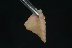 Figure 2: An e-PRF membrane prepared for use. Case performed by Dr Ezio Gheno. Figure 2: An e-PRF membrane prepared for use. Case performed by Dr Ezio Gheno.