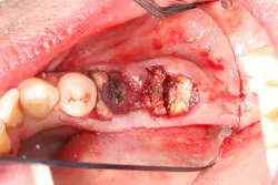 Figure 3A: Clinical case using an e-PRF membrane as a substitute for a collagen barrier membrane following extraction site management. (A) Sectioning of teeth. (B) Following tooth extraction. (C) Allograft bone grafting with PRF fragments. (D) Fabrication of the e-PRF membrane following heat treatment at 75 °C for 10 minutes in the Bio-Heat device. (E) e-PRF membrane in place with suturing (Video is found in QR code 4). (F) One week postoperative. Note the excellent healing. (G) Eight weeks post-op. (H) Four months post-op. Case performed by Dr Nathan Estrin. Figure 3A: Clinical case using an e-PRF membrane as a substitute for a collagen barrier membrane following extraction site management. (A) Sectioning of teeth. (B) Following tooth extraction. (C) Allograft bone grafting with PRF fragments. (D) Fabrication of the e-PRF membrane following heat treatment at 75 °C for 10 minutes in the Bio-Heat device. (E) e-PRF membrane in place with suturing (Video is found in QR code 4). (F) One week postoperative. Note the excellent healing. (G) Eight weeks post-op. (H) Four months post-op. Case performed by Dr Nathan Estrin.
