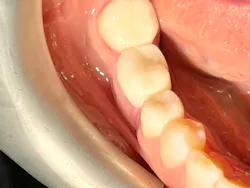 Figure 4A: Use of the e-PRF membrane for GBR. (A, B) Lower first molar demonstrating deficiency of the buccal surface of the implant. (C) Flap elevation demonstrating complete loss of the buccal bone of this malpositioned implant. (D) Implant removal. (E) Grafting of the defect site with bone particles mixed with PRF fragments. (F) Fabrication of an e-PRF membrane. (G, H) Placement of the e-PRF membrane covering the grafted defect (Video is found in QR code 5). (I) Final soft tissue closure. Case performed by Dr. Alan Rene Espinoza. Figure 4A: Use of the e-PRF membrane for GBR. (A, B) Lower first molar demonstrating deficiency of the buccal surface of the implant. (C) Flap elevation demonstrating complete loss of the buccal bone of this malpositioned implant. (D) Implant removal. (E) Grafting of the defect site with bone particles mixed with PRF fragments. (F) Fabrication of an e-PRF membrane. (G, H) Placement of the e-PRF membrane covering the grafted defect (Video is found in QR code 5). (I) Final soft tissue closure. Case performed by Dr. Alan Rene Espinoza.