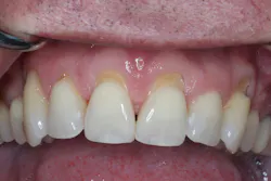 Figure 5A: Use of e-PRF for the management of multiple gingival recessions. (A) Preoperative images demonstrating multiple anterior gingival recessions. (B, C) Postsurgical result following tunneling with e-PRF via a vestibular incision (Video is found in QR code 6). (D) Two weeks post-op; note the excellent soft tissue healing. (E) Eight weeks post-op. Case performed by Dr Nathan Estrin. Figure 5A: Use of e-PRF for the management of multiple gingival recessions. (A) Preoperative images demonstrating multiple anterior gingival recessions. (B, C) Postsurgical result following tunneling with e-PRF via a vestibular incision (Video is found in QR code 6). (D) Two weeks post-op; note the excellent soft tissue healing. (E) Eight weeks post-op. Case performed by Dr Nathan Estrin.