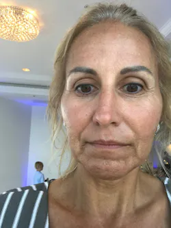 Figure 6A: (A) Mid-40-year-old female patient with pronounced Mariotte lines, deep nasolabial folds and an overall aged facial appearance. (B) Final outcome following three treatments with 100% natural approaches, including laser therapy, microneedling with PRF, and e-PRF injections. Case performed by Dr. Scott Delboccio. Figure 6A: (A) Mid-40-year-old female patient with pronounced Mariotte lines, deep nasolabial folds and an overall aged facial appearance. (B) Final outcome following three treatments with 100% natural approaches, including laser therapy, microneedling with PRF, and e-PRF injections. Case performed by Dr. Scott Delboccio.