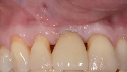 Figure 7A: (A) Clinical photograph demonstrating maxillary anterior teeth with multiple black triangles. (B-C) Injection techniques of the Alb-PRF mixture into various papillas. (D) Final clinical photographs after injections (Video found in QR code 8). Case performed by Dr Ezio Gheno. Figure 7A: (A) Clinical photograph demonstrating maxillary anterior teeth with multiple black triangles. (B-C) Injection techniques of the Alb-PRF mixture into various papillas. (D) Final clinical photographs after injections (Video found in QR code 8). Case performed by Dr Ezio Gheno.