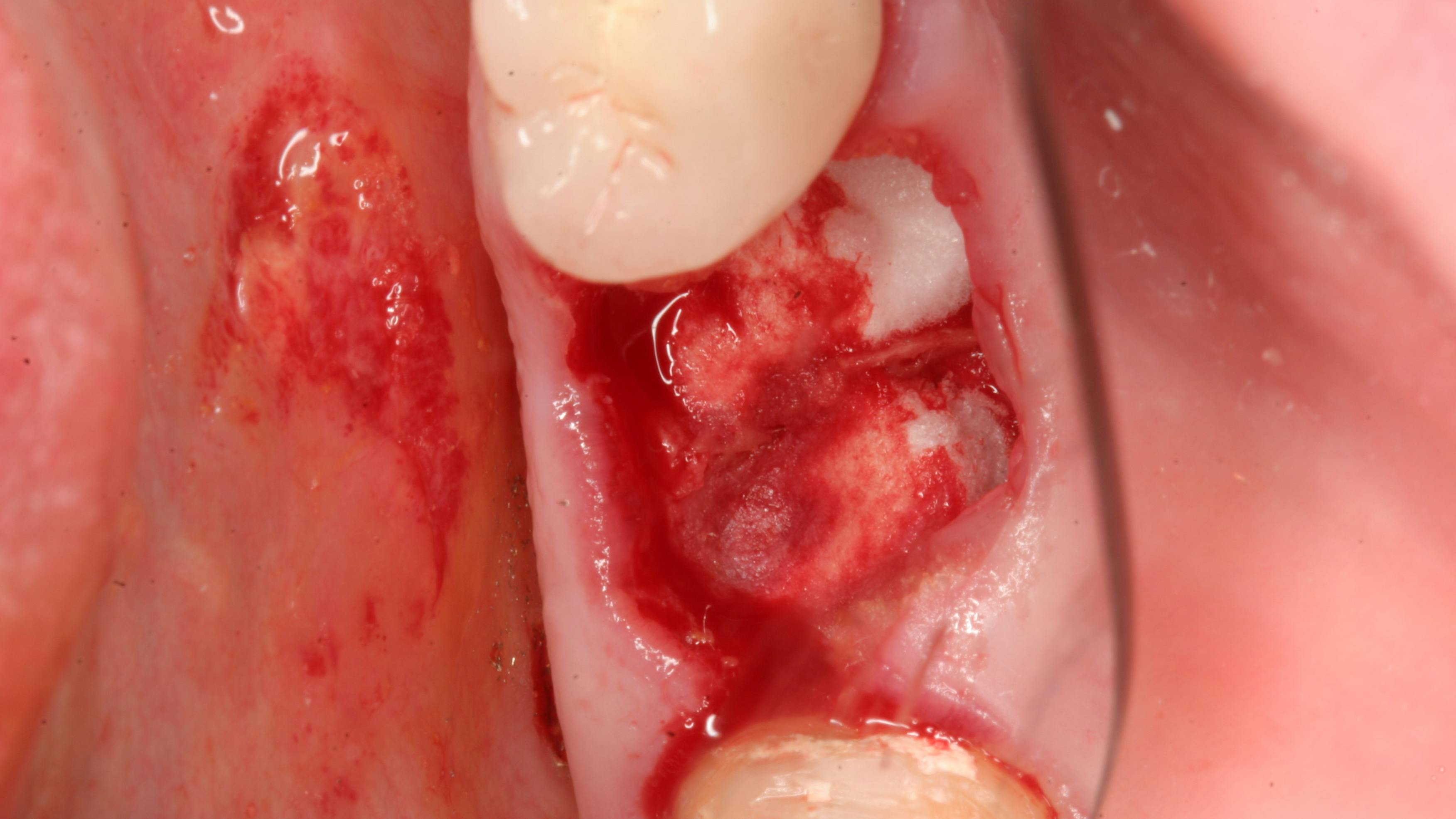 hemostasis