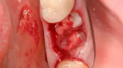 hemostasis