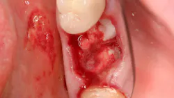 hemostasis