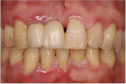 inflammation of the gums