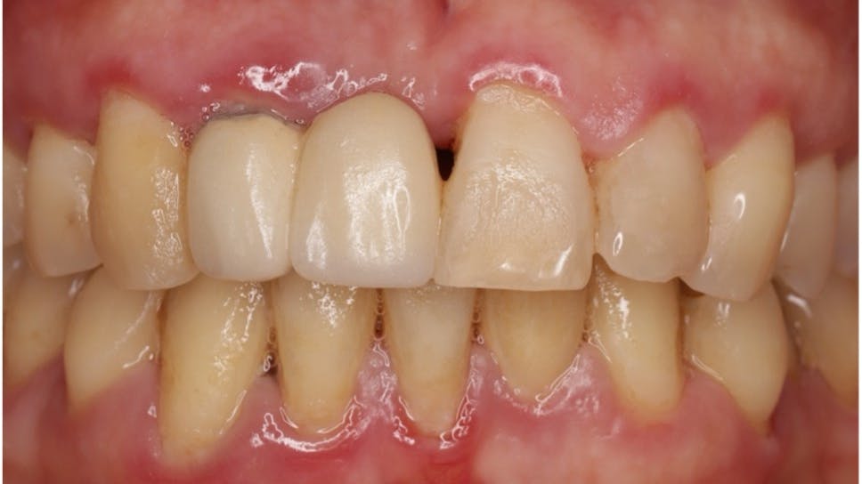 inflammation of the gums