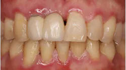 inflammation of the gums