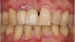 inflammation of the gums