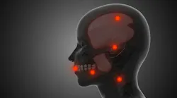 profile of a head noting temporomandibular joint (TMJ) myofascial pain and trigger points