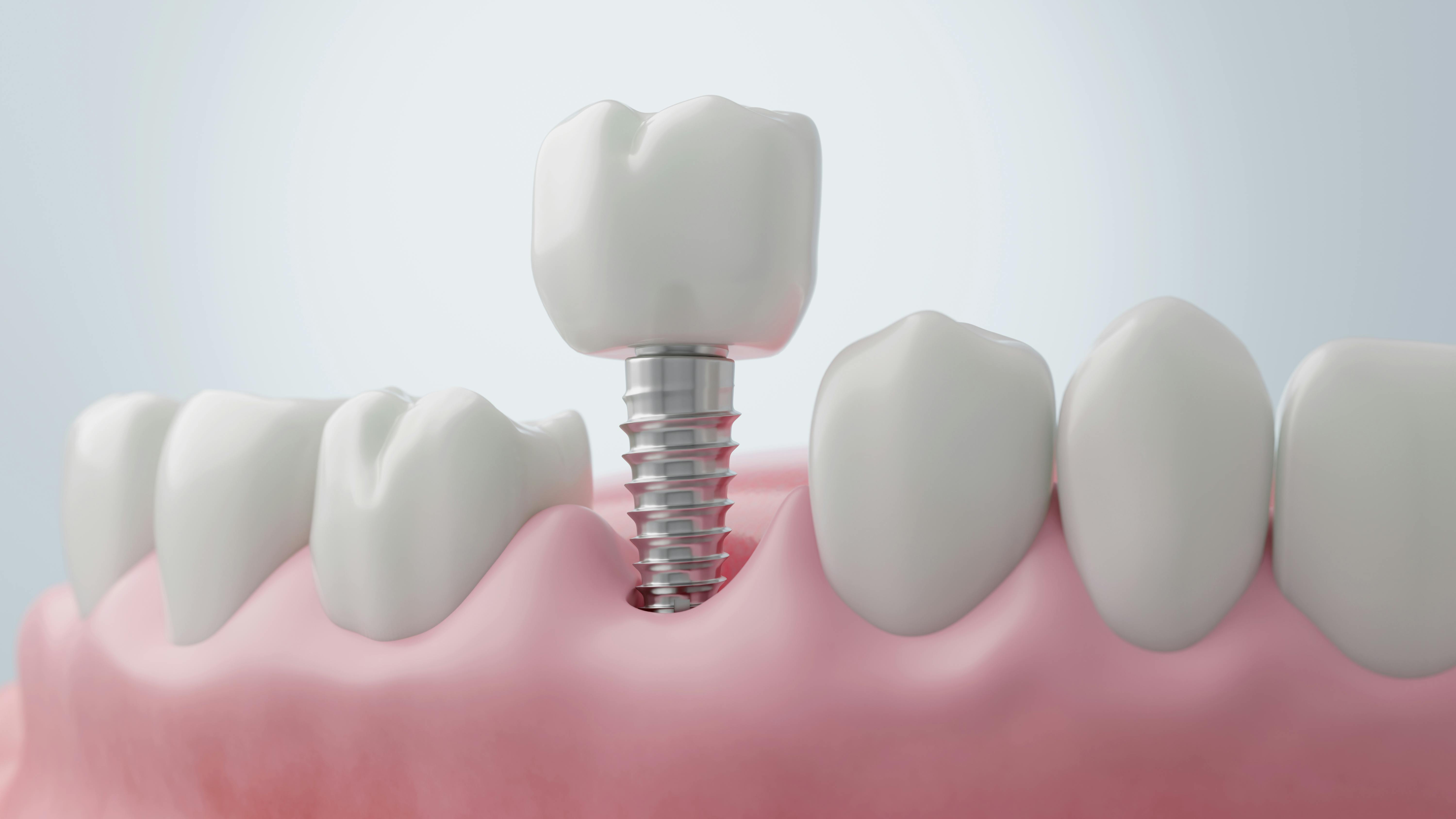model of a dental implant