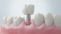 model of a dental implant